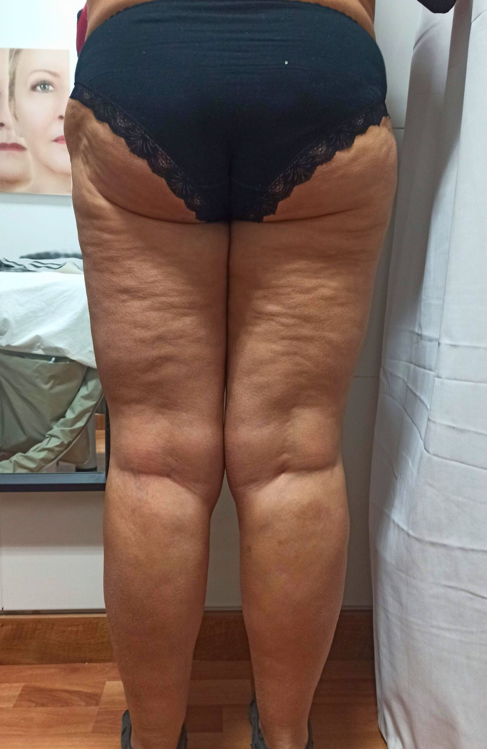 maderoterapia - corporal - piernas - antes - Masajes en Málaga