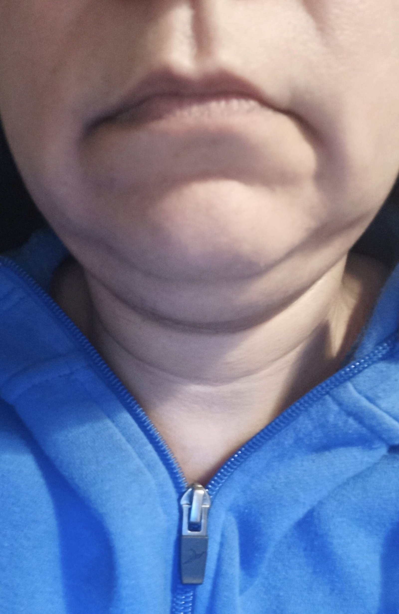 maderoterapia - facial - antes - Masajes en Málaga