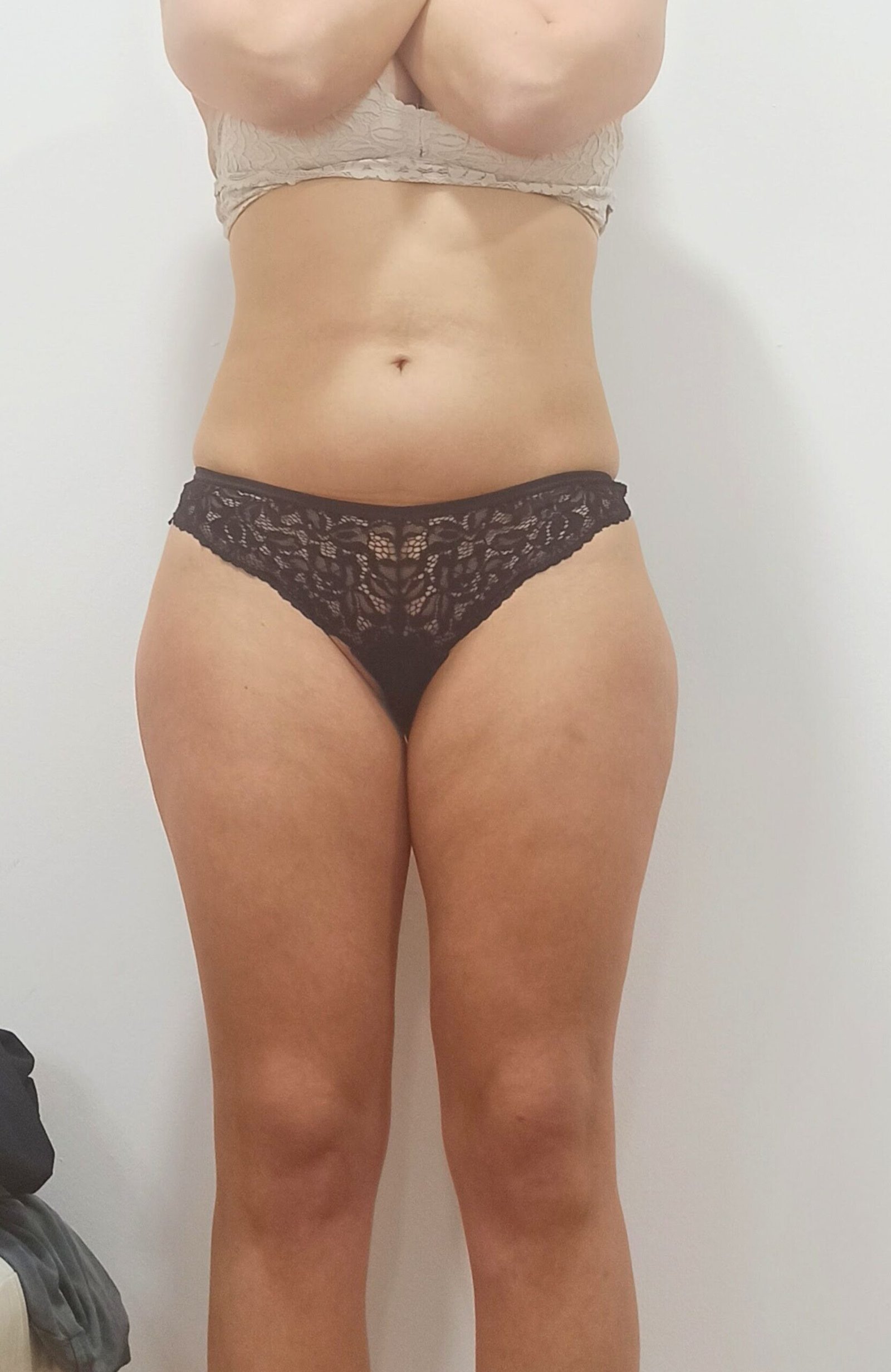 Abdomen Frontal Antes