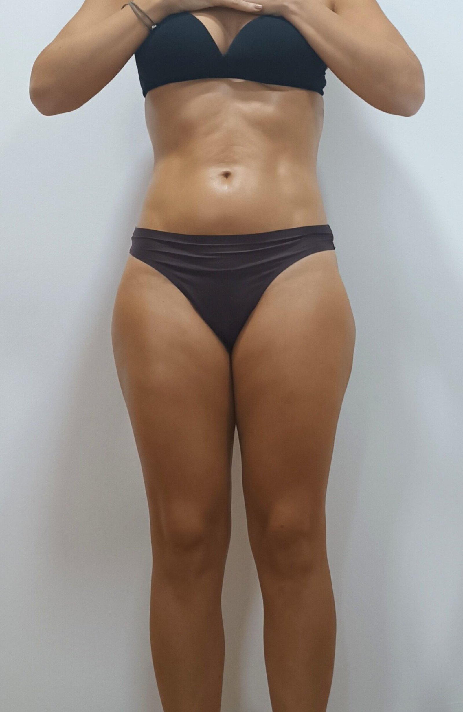 Abdomen Frontal Después